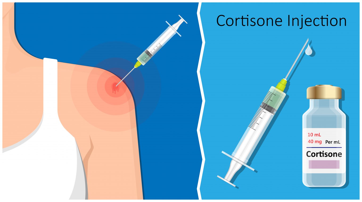 Steroid Cortisone Injections